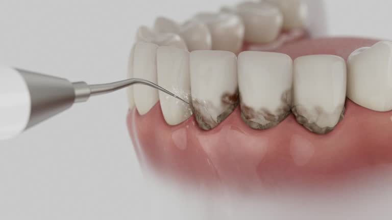 Trusted Tooth Extraction service in Country Club Estates, GA - Dentist Open Now
